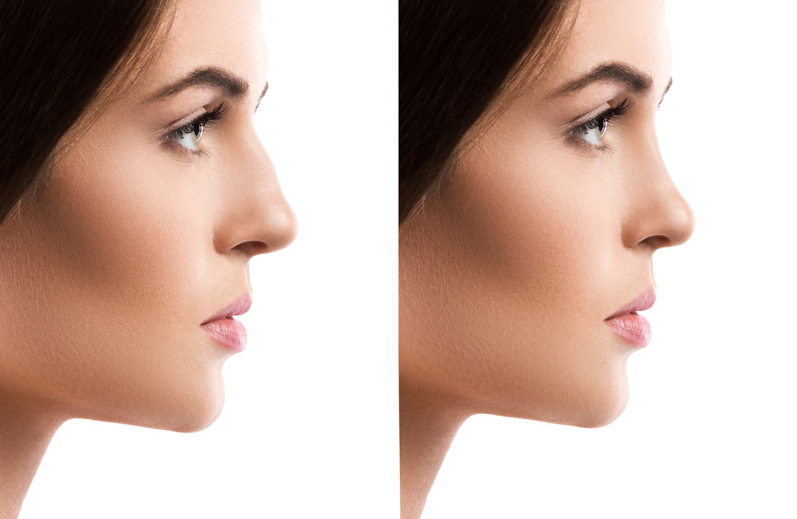 Edad ideal para la rinoplastia: ¿Cuándo es el momento adecuado?